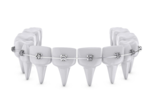 Dental Implants Brisbane