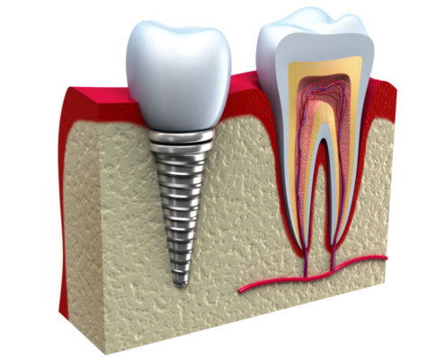 Dental Implants Brisbane