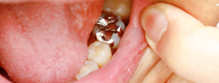 dental fillings